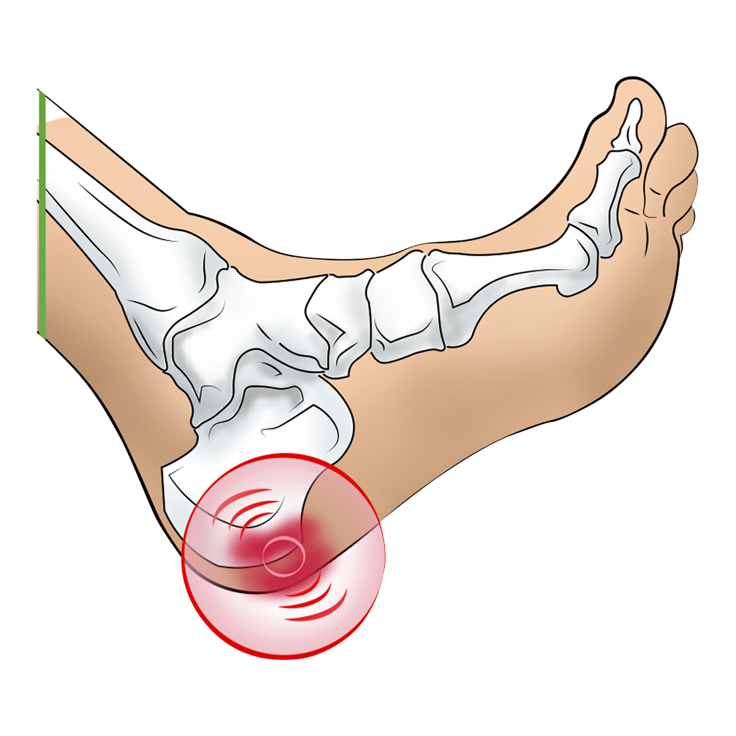 Fersenspornkissen, 1 Paar